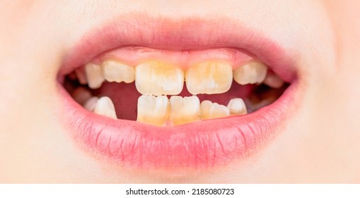 Close Up Of Unhealthy Baby Teeths. Kid Patient Open Mouth Showing Cavities Teeth Decay. Bad Teeth Child. Portrait Boy With Bad Teeth. Child Smile And Show Her Crowding Tooth.