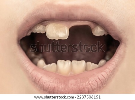 Similar – gap between one’s teeth