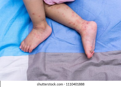 Close Up, Foot And Hand Baby Affected By Foot, Hand And Mouth Disease HFMD