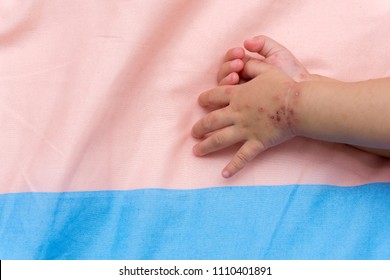 Close Up, Foot And Hand Baby Affected By Foot, Hand And Mouth Disease HFMD