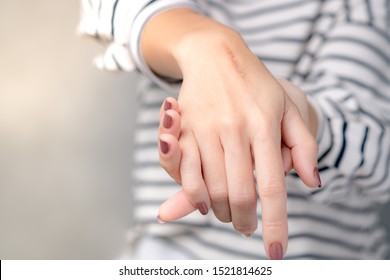 Close Up: Hands Of A Woman With First Degree Heat Burn Scar About A Months After Injured. The Wound Damage On Epidermis Outermost Layer Of Skin And Now It's In Healing Process, Scar Fading Remedies.