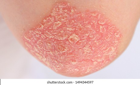 CLOSE UP, MACRO: Detail of dry silver scales covering red inflamed skin on an elbow affected by autoimmune disease called psoriasis. Skin allergy with severe symptoms. Dermatitis rash and ugly eczema