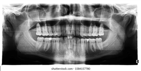 182 Third molar Stock Photos, Images & Photography | Shutterstock