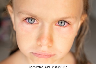 Close Up. Sad Cry Little Girl Child Red Eyes With Conjunctivitis, Viral On Eye. Allergy To Pollen. Irritated Red Bloodshot Eye, Red And Irritated Human Eye