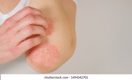 CLOSE UP: Unrecognizable young woman suffering from autoimmune incurable dermatological skin disease called psoriasis. Female gently scratching red, inflamed, scaly rash on elbows. Psoriatic arthritis