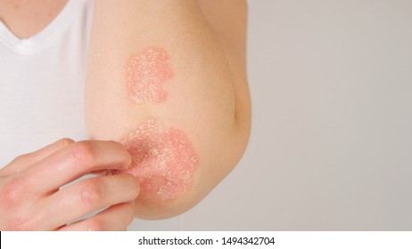 CLOSE UP: Unrecognizable young woman suffering from autoimmune incurable dermatological skin disease called psoriasis. Female gently scratching red, inflamed, scaly rash on elbows. Psoriatic arthritis - Shutterstock ID 1494342704