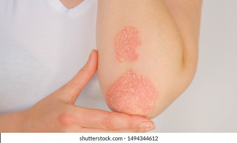 CLOSE UP: Unrecognizable young woman suffering from autoimmune incurable dermatological skin disease called psoriasis. Large red, inflamed, flaky rash on elbows. Joints affected by psoriatic arthritis