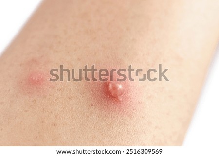 Close up variola or pox or smallpox or chickenpox on arm
