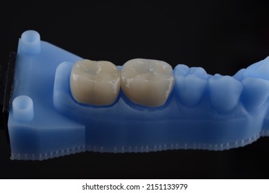 Close Up View Of All Ceramic Dental Crown On Printing Model, Fabricated With CAD CAM Technology With Black Background.