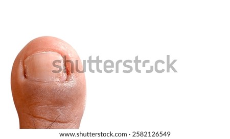 Close up view of the big toe with damaged and pitted nail
