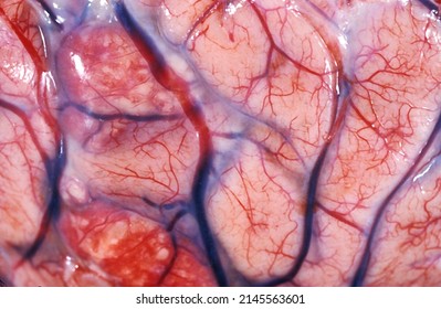 Close view of brain surface showing the leptomeningeal blood vessels. There is a moderate congestion and areas of subarachnoid diffuse hemorrhages of on the left side.