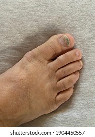 Close Up View Of A Bruised Toe Nail With Purple Discoloration Due To An Injury. Blood Clot Can Occur With Black Stains