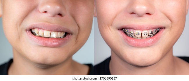 Close Up View Collage Photography Of Smiling Mouth Of Young White Kid With Overbite Teeth Before And After Fixing Metal Modern Braces Construction On Teeth. Shoot The Same Day.