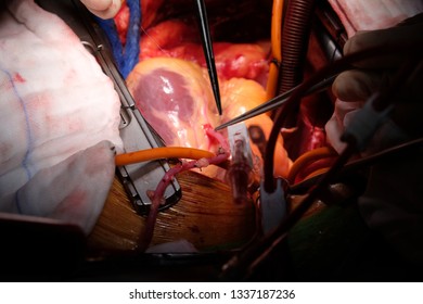 Close Up View Of Coronary Artery Bypass Graft Opertion (CABG)