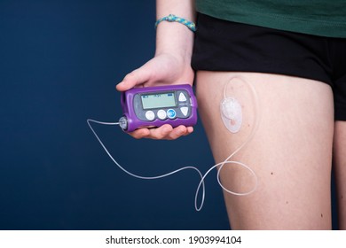 Close Up View Of A Diabetic Child With An Insulin Pump.Child Diabetes Concept.