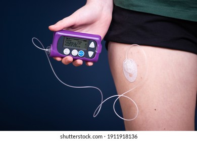 Close Up View Of A Diabetic Child With An Insulin Pump.Child Diabetes Concept.
