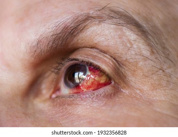 Close Up View Of Female Eye With Hemorrhage