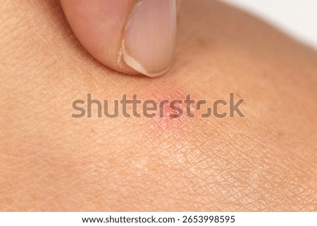 Close up view of flea bites on lower legs and feet skin.