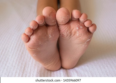 Feet Peeling Images Stock Photos Vectors Shutterstock