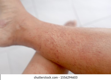 big red bumps on legs that itch