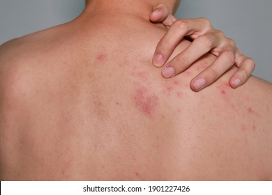 Close up view of man scratching  his back .Painful back skin rash with blisters in a limited area.A man who having varicella blister , , , chickenpox,Herpes zoster or Shingles.