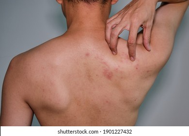 Close up view of man scratching  his back .Painful back skin rash with blisters in a limited area.A man who having varicella blister , , , chickenpox,Herpes zoster or Shingles.