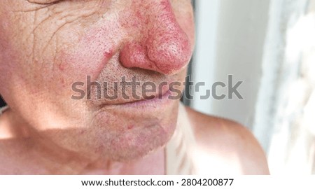 Close up view of a mature man face with phymatous rosacea and rhinophyma skin condition. Dermatological skin disease concept showing bulbous nose and facial redness.
