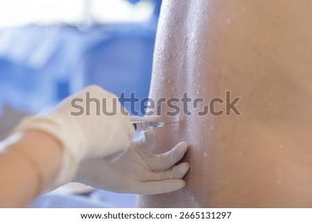 Close view of needle placed in the lower back for neuraxial anesthesia using sterile technique in a hospital setting for surgery pain control