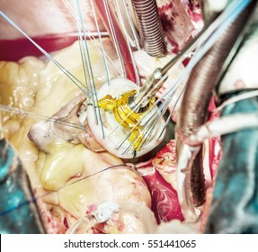 Close Up View On Artificial Heart Valve Made Of Bovine Pericardium 