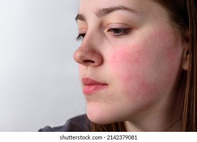 Close Up View On The Cheek Of A Woman With Red Cheeks After The Wind. Allergy Concept. 