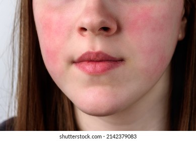 Close Up View On The Cheek Of A Woman With Red Cheeks After The Wind. Allergy Concept. 