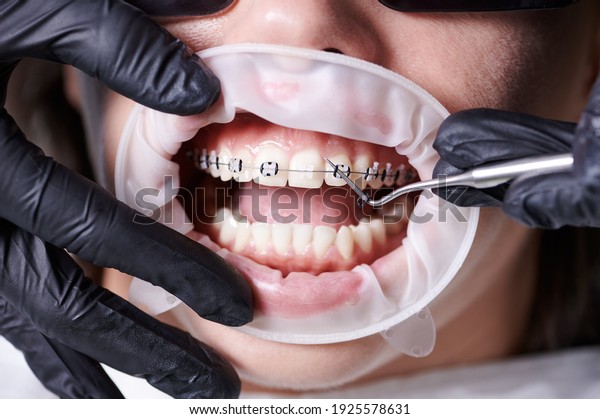 Close up view on dentist\'s hands in black\
gloves taking off old black rubber bands from ceramic braces with a\
help of dental hook to replace rusty wire which connects the\
braces. Concept of\
dentistry