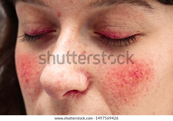 A close up view\
on the face of a young caucasian lady, suffering from a severe case\
of rosacea, with facial redness and dilated blood vessels of the\
eyelids, nose and cheeks.
