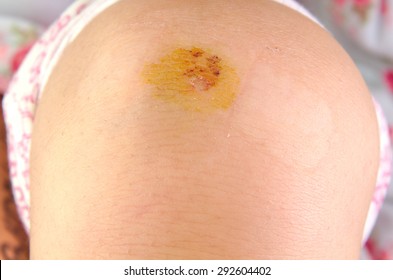 Close Up View On A Girl Scraped Knee