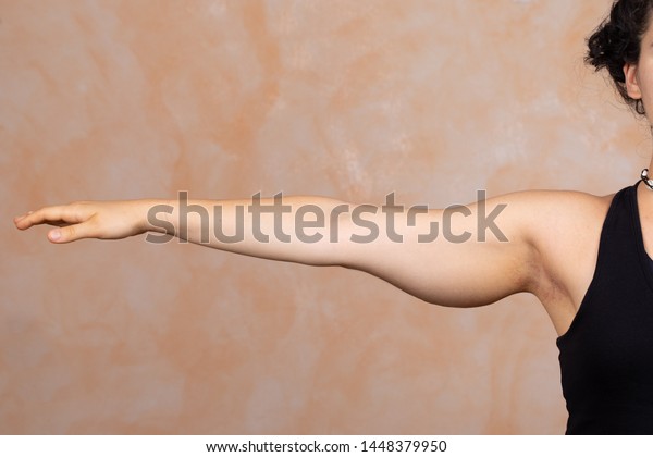 白人の女性の腕を伸ばしたところの接写 上腕部には毛むくじゃらの筋肉と脂肪が見られる 一般にビンゴウイングと呼ばれ 整形手術を受ける の写真素材 今すぐ編集
