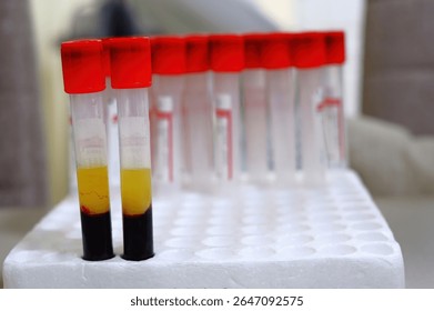 Close up view of several blood sample tubes with red caps, showing separated serum layers, in a white foam rack. The tubes contain varying amounts of blood and serum,