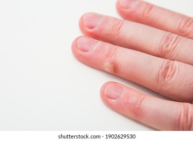 Wart Nail Hd Stock Images Shutterstock