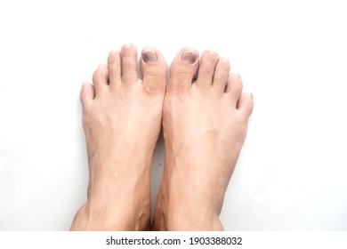 Close Up View Of A Toe Nail With Purple Discoloration Due To An Injury. The Bruised Toe Nail Is Caused By Wearing The Wrong Shoe Size 