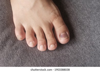 Close Up View Of A Toe Nail With Purple Discoloration Due To An Injury. The Bruised Toe Nail Is Caused By Wearing The Wrong Shoe Size 