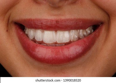 Close Up View Of A Woman Wearing Invisalign Braces