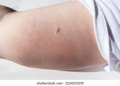 Close Up View Of A Woman's Birth Control Implant Removal Scar, Several Months After The Device's Removal