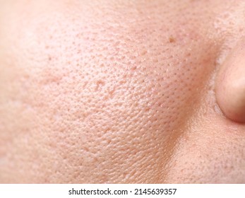 Close Up View Of A Woman's Skin With Big Pores Around The Nose Area On Oily Facial Skin Type