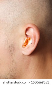 Close Up View Of A Young Man With Bloody Cotton Wool In His Ear. Concept Of Ear Infections, Bleeding And Ear Pain