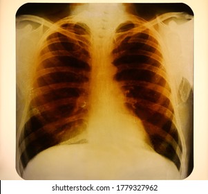 Close up vintage roentgenogram or photofluorogram (fluorogram) with ribcage and lungs