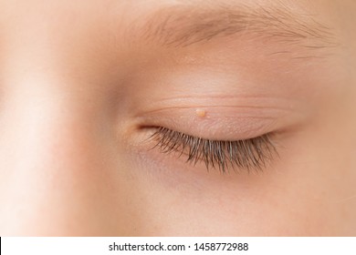Close up of wart on eyelid. Young girl with papilloma on skin around eye, macro