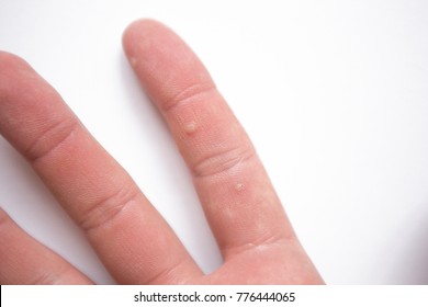 warts on hands small)