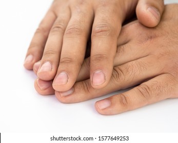 Close up white male hands with damaged fingernail bed and skin. Showing details of injured cuticles. Waiting for manicure procedure
