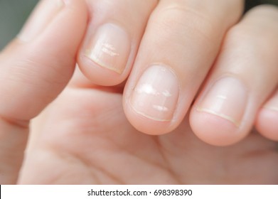 close up white spot on finger nails called leukonychia, sickness concept