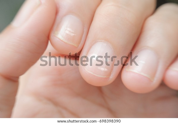 爪白斑という 指の爪の白い斑点 の写真素材 今すぐ編集