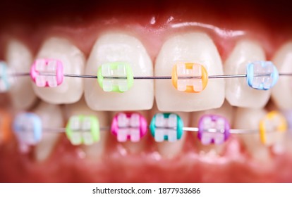 Close up of white teeth with wired orthodontic braces. Patient demonstrating dental brackets with multicolored rubber bands. Concept of dentistry, orthodontic treatment and stomatology.